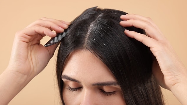 Mulher com caspa no cabelo em fundo bege